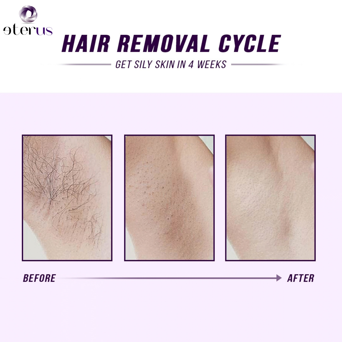 Laser IPL Hair Removal