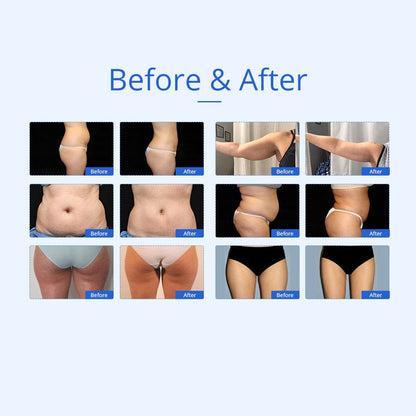 Shape Tactics 7-in-1 40K Ultrasonic Cavitation & RF Hot-Cold Therapy System