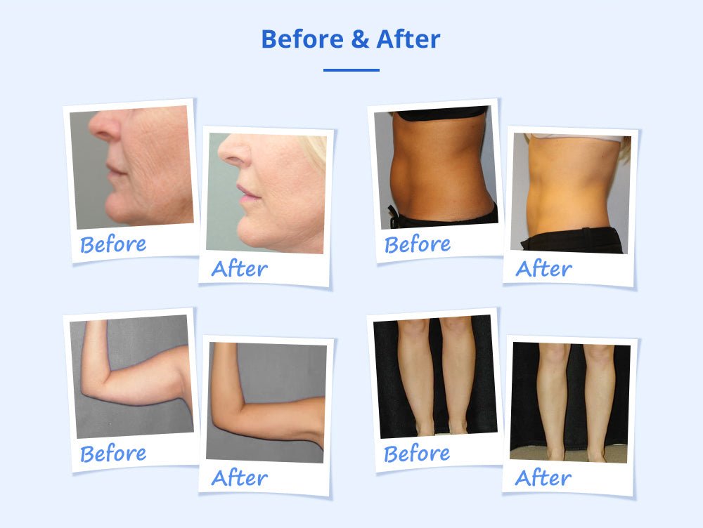 Shape Tactics Cryotherapy 40K Cavitation & RF Contouring System