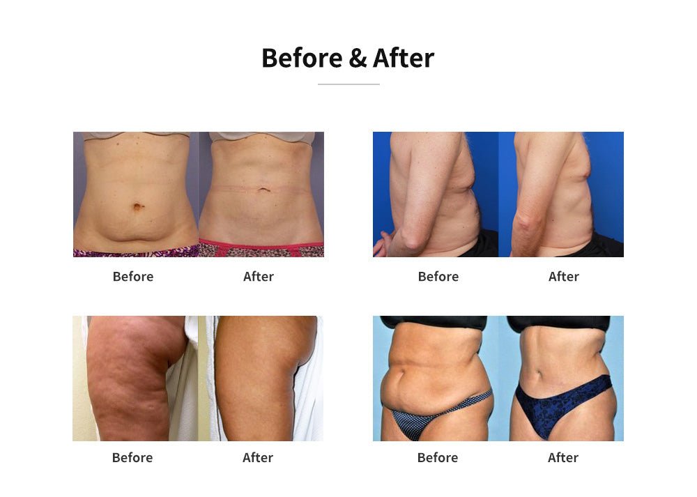 Shape Tactics Dual-Handle Cooling Cavitation & RF Contouring System